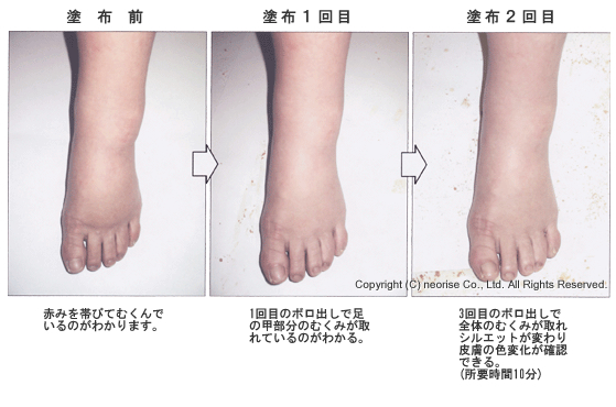 マテリアリフレ足のむくみ施術例画像