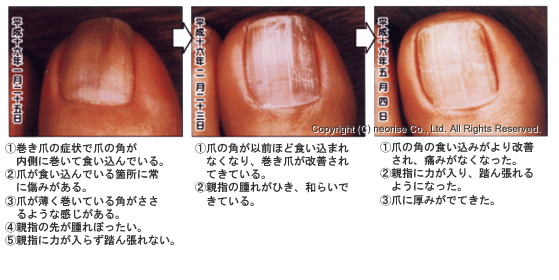 マテリアリフレ巻き爪体験例画像